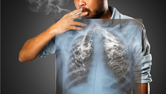 El cigarro: el villano número uno en la saga del cáncer de pulmón.