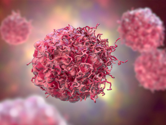 Día Internacional del Sarcoma