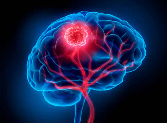 Un Estudio Reveló un Tumor Cerebral del Tamaño de una Pelota de Golf